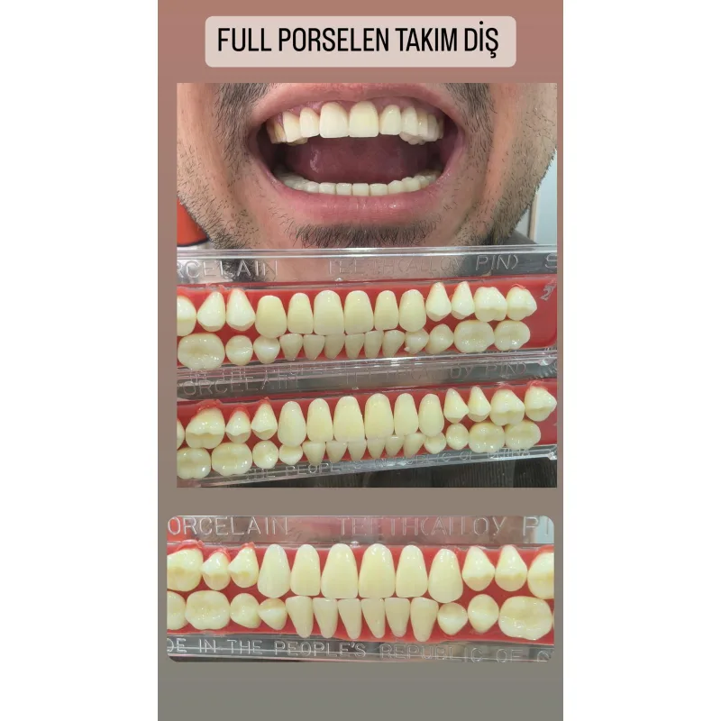 Full Poselen Takim Diş