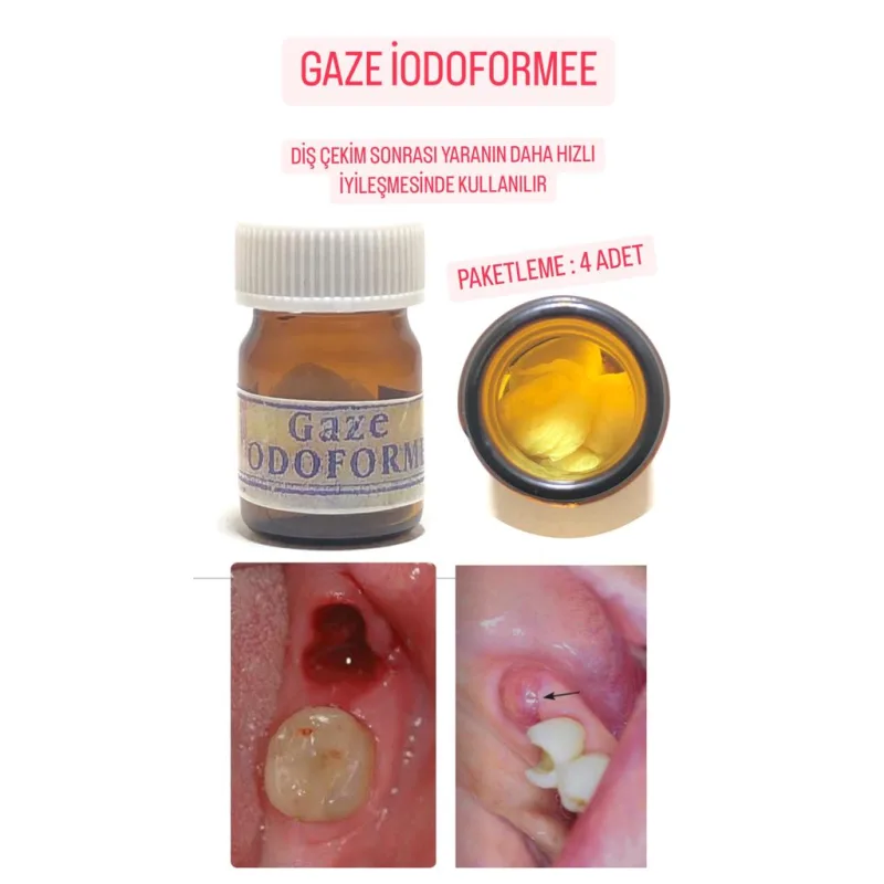 Gaze İodoformee Diş Çekimi Sonrasi Yaranin Daha Hizli İyileşmesinde Kullanilir