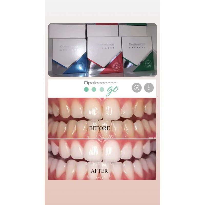 Opalescence Ev Tipi Beyazlatma